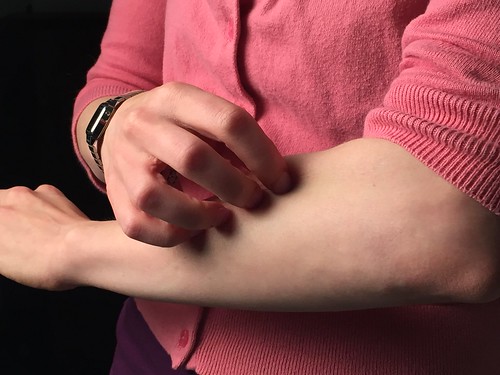 Can bugs cause allergies?